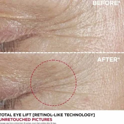Total Eye Lift><noscript><img width=